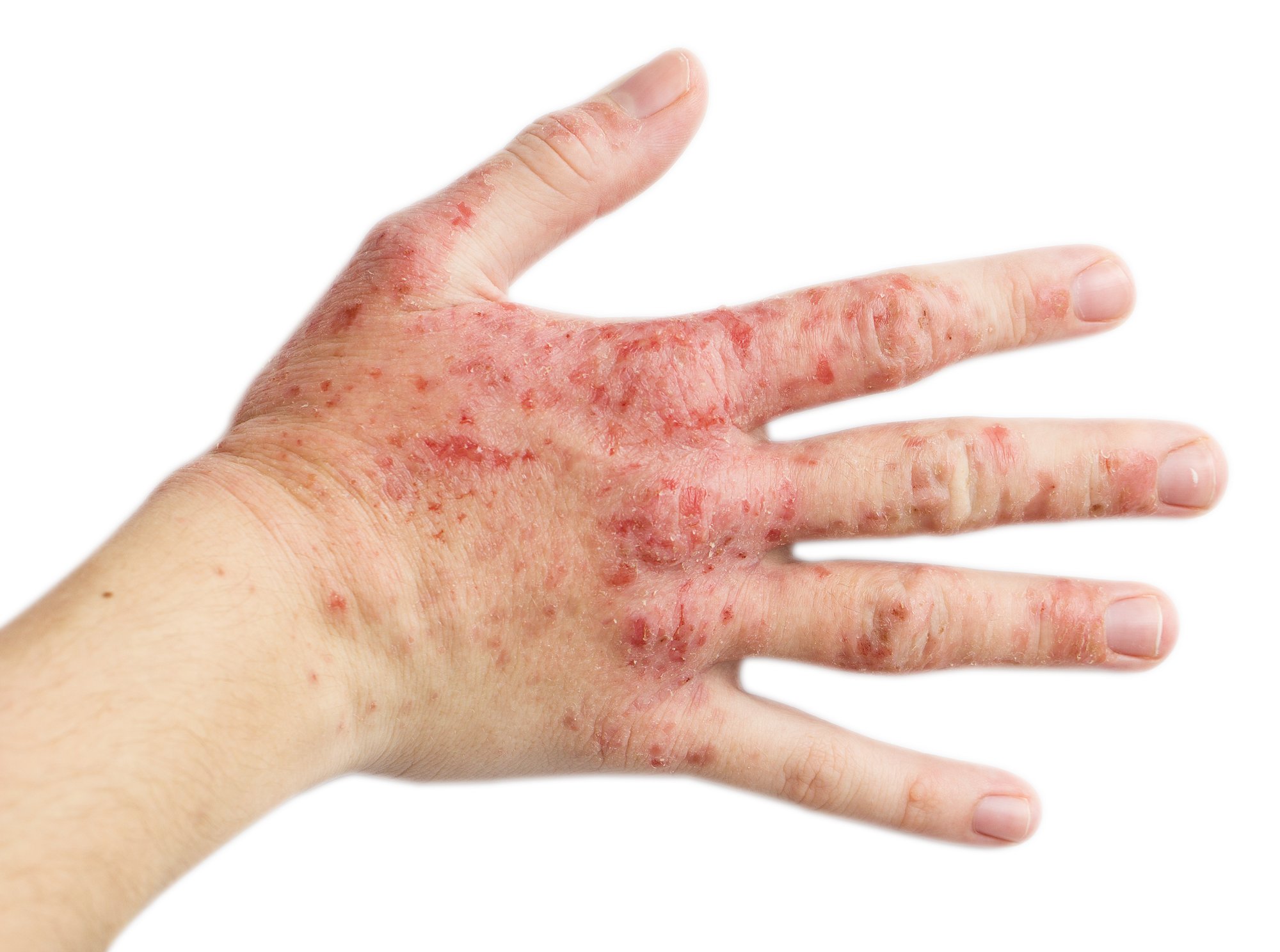 Contact dermatitis